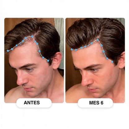 Kivarea™ Sistema de Regeneración Capilar